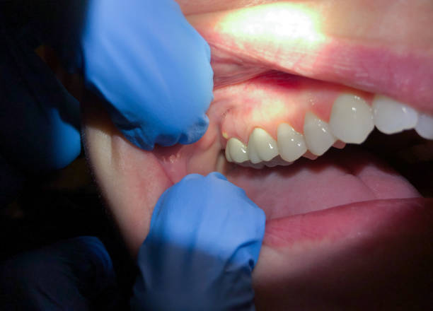Best Emergency Treatment for Toothache in Aberdeen, OH