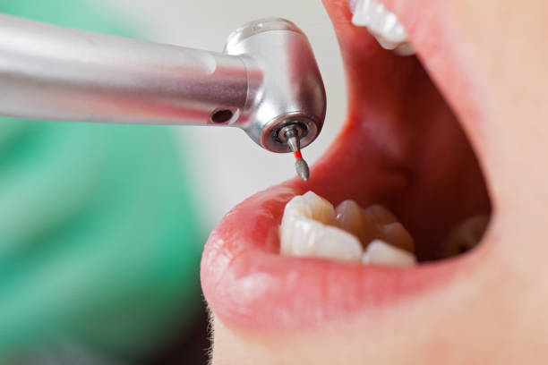 Best Emergency Tooth Extraction in Aberdeen, OH